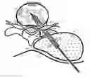 Fig. 01 - Disc shunt delivery with stepped needle