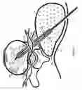 Fig. 07 - Disc shunt delivery with stepped needle