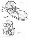 Fig. 08 - Disc shunt delivery with stepped needle