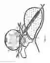 Fig. 09 - Disc shunt delivery with stepped needle