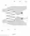 Fig. 17 - EXPANDABLE PYLORIC ANCHORS AND METHODS FOR SECURING INTESTINAL BYPASS SLEEVES