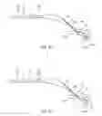 Fig. 05 - Facilitation of antegrade insertion of a guidewire into the superficial femoral artery