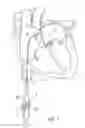 Fig. 02 - Apparatus for safe performance of transseptal technique and placement and positioning of an ablation catheter