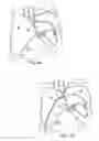 Fig. 07 - Apparatus for safe performance of transseptal technique and placement and positioning of an ablation catheter