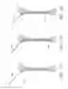 Fig. 40 - SNAP AND TWIST SEGMENTED INTRAMEDULLARY SYSTEM, APPARATUS AND ASSOCIATED METHODS