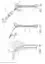 Fig. 41 - SNAP AND TWIST SEGMENTED INTRAMEDULLARY SYSTEM, APPARATUS AND ASSOCIATED METHODS
