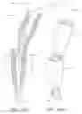 Fig. 50 - SNAP AND TWIST SEGMENTED INTRAMEDULLARY SYSTEM, APPARATUS AND ASSOCIATED METHODS