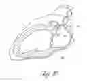 Fig. 07 - Method and device for left atrial appendage occlusion