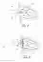 Fig. 08 - Method and device for left atrial appendage occlusion