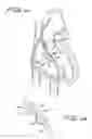 Fig. 08 - SEPTAL DEFECT CLOSURE DEVICE