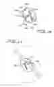 Fig. 09 - SEPTAL DEFECT CLOSURE DEVICE