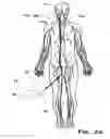 Fig. 03 - System and method for mechanically positioning intravascular implants