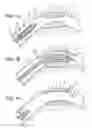 Fig. 02 - Bioerodible endoprostheses and methods of making the same