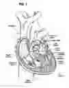 Fig. 02 - Systems for rapidly deploying surgical heart valves