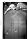 Fig. 06 - Adjustable suture-button construct for knotless stabilization of cranial cruciate deficient ligament stifle