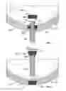 Fig. 02 - Acetabular cup fixation