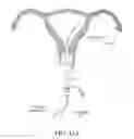 Fig. 13 - METHODS, SYSTEMS AND DEVICES FOR PERFORMING GYNECOLOGICAL PROCEDURES