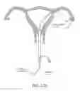 Fig. 14 - METHODS, SYSTEMS AND DEVICES FOR PERFORMING GYNECOLOGICAL PROCEDURES