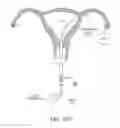 Fig. 15 - METHODS, SYSTEMS AND DEVICES FOR PERFORMING GYNECOLOGICAL PROCEDURES