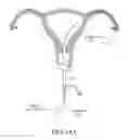 Fig. 17 - METHODS, SYSTEMS AND DEVICES FOR PERFORMING GYNECOLOGICAL PROCEDURES