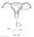 Fig. 19 - METHODS, SYSTEMS AND DEVICES FOR PERFORMING GYNECOLOGICAL PROCEDURES