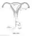 Fig. 20 - METHODS, SYSTEMS AND DEVICES FOR PERFORMING GYNECOLOGICAL PROCEDURES