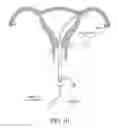 Fig. 22 - METHODS, SYSTEMS AND DEVICES FOR PERFORMING GYNECOLOGICAL PROCEDURES