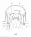 Fig. 04 - Removable attachment system