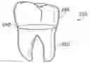 Fig. 01 - Dental implant fabrication and insertion methods and personalized dental implant for use therein