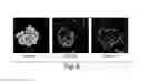 Fig. 07 - Treatment of chronic nephropathies using soluble complement receptor type I (sCR1)