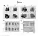 Fig. 07 - Pharmaceutical composition used in treatment of hyperproliferative skin conditions and malignant melanomas comprising pachastrissamine as active ingredient