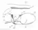 Fig. 01 - Implantable Sling Having Bladder Support