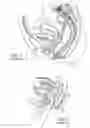 Fig. 02 - Correction of stress urinary incontinence