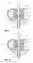 Fig. 06 - Biopsy inlet valve improvements