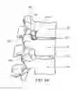 Fig. 04 - Cannulotome