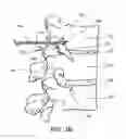 Fig. 05 - Cannulotome