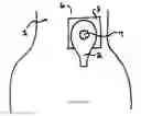 Fig. 02 - Dressing and method for cleaning and protecting a laparoscopic camera lens intra-abdominally, stomas, appendages, and insertion sites of tubes and catheters