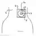 Fig. 03 - Dressing and method for cleaning and protecting a laparoscopic camera lens intra-abdominally, stomas, appendages, and insertion sites of tubes and catheters