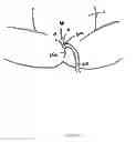 Fig. 09 - Dressing and method for cleaning and protecting a laparoscopic camera lens intra-abdominally, stomas, appendages, and insertion sites of tubes and catheters