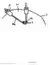 Fig. 20 - Dressing and method for cleaning and protecting a laparoscopic camera lens intra-abdominally, stomas, appendages, and insertion sites of tubes and catheters