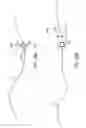 Fig. 111 - Method for providing surgical access