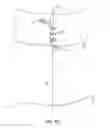 Fig. 26 - Method for providing surgical access