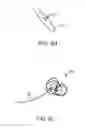 Fig. 32 - Method for providing surgical access