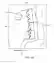 Fig. 44 - Method for providing surgical access