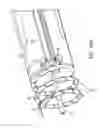 Fig. 61 - Method for providing surgical access