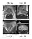 Fig. 04 - System and method for integrated biopsy and therapy