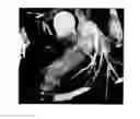 Fig. 01 - Method and system for automatic native and bypass coronary ostia detection in cardiac computed tomography volumes