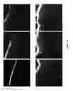 Fig. 03 - Photodynamic therapy including light pretreatment
