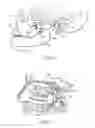 Fig. 02 - Stimulation method for the sphenopalatine ganglia, sphenopalatine nerve, or vidian nerve for treatment of medical conditions