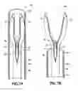 Fig. 08 - Methods and systems for submucosal implantation of a device for diagnosis and treatment with a therapeutic agent